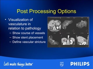 Post Processing Options
• Visualization of
vasculature in
relation to pathology
– Show course of vessels
– Show stent placement
– Define vascular stricture
 