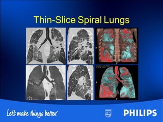 Thin-Slice Spiral Lungs
 