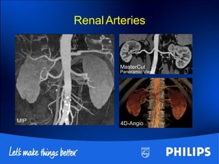 MIP 4D-Angio
MasterCut
Panoramic View
RenalArteries
 