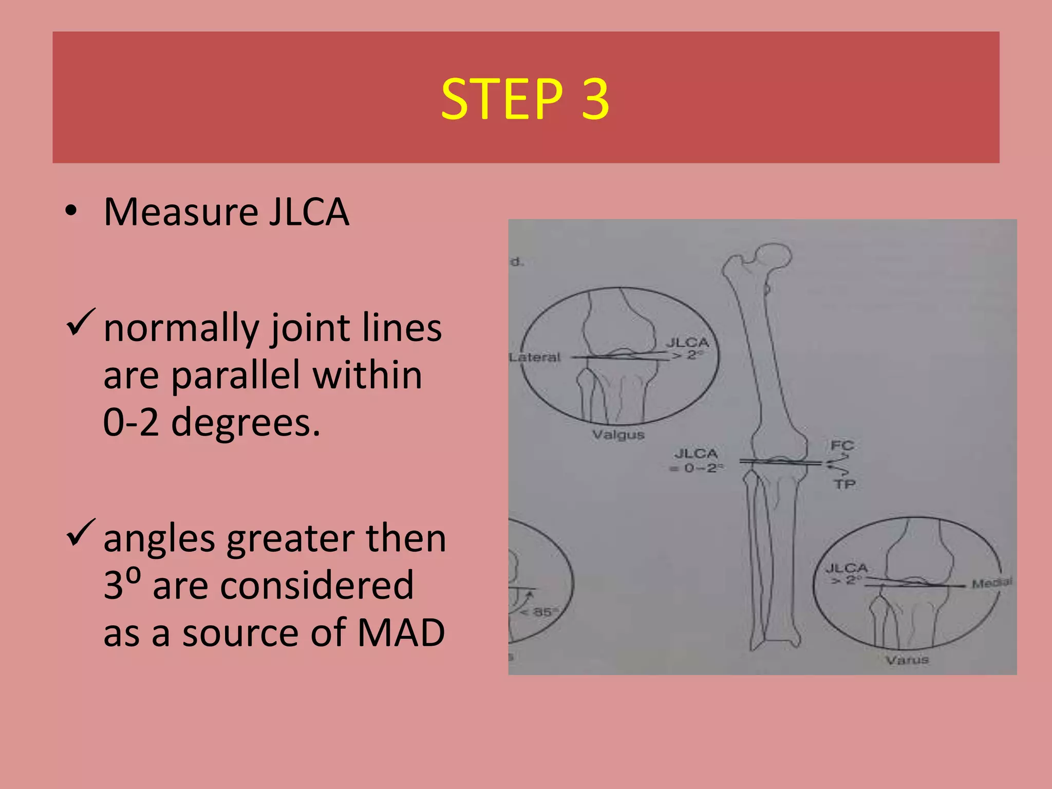 語学・辞書・学習参考書 principles of deformity correction Tibial Uniapical Deformity - YouTube