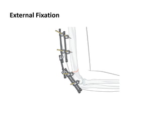 Basic Principles of Fracture Management | PDF