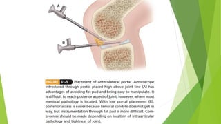 Basic principles of knee arthroscopy Part 2.pptx