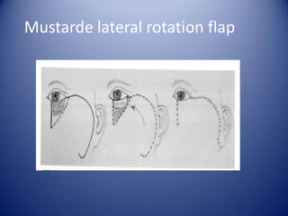 Mustarde lateral rotation flap

 