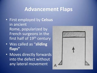 Advancement Flaps
• First employed by Celsus
in ancient
Rome, popularized by
French surgeons in the
first half of 19th century
• Was called as “sliding
flaps”
• Moves directly forwards
into the defect without
any lateral movement

 