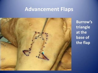 Advancement Flaps
Burrow’s
triangle
at the
base of
the flap

 
