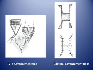 V-Y Advancement flap

Bilateral advancement flaps

 
