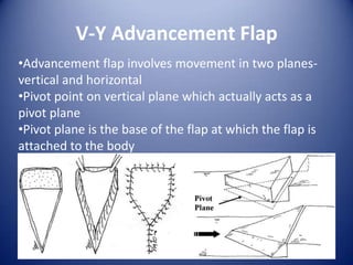 V-Y Advancement Flap
•Advancement flap involves movement in two planesvertical and horizontal
•Pivot point on vertical plane which actually acts as a
pivot plane
•Pivot plane is the base of the flap at which the flap is
attached to the body

 