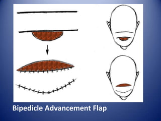 Bipedicle Advancement Flap

 