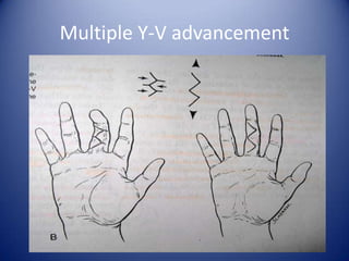 Multiple Y-V advancement

 