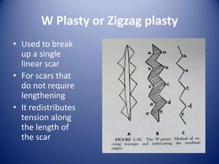 W Plasty or Zigzag plasty
• Used to break
up a single
linear scar
• For scars that
do not require
lengthening
• It redistributes
tension along
the length of
the scar

 