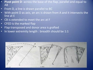 • Pivot point D- across the base of the flap, parallel and equal to
AB
• From D, a line is drawn parallel to BC
• With point D as axis, an arc is drawn from A and it intersects the
line at E
• CB is extended to meet the arc at F
• CFED is the marked flap
• Flap transposed and donor area is grafted
• In lower extremity length : breadth should be 1:1

 