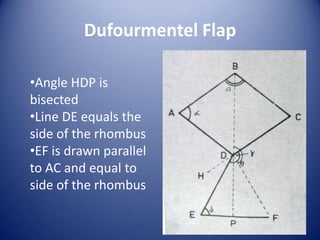 Dufourmentel Flap
•Angle HDP is
bisected
•Line DE equals the
side of the rhombus
•EF is drawn parallel
to AC and equal to
side of the rhombus

 