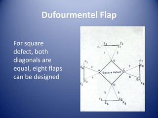Dufourmentel Flap
For square
defect, both
diagonals are
equal, eight flaps
can be designed

 