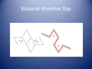 Bilateral Rhombic flap

 