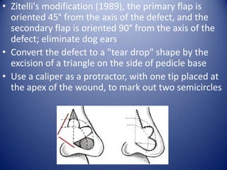 • Zitelli's modification (1989), the primary flap is
oriented 45° from the axis of the defect, and the
secondary flap is oriented 90° from the axis of the
defect; eliminate dog ears
• Convert the defect to a "tear drop" shape by the
excision of a triangle on the side of pedicle base
• Use a caliper as a protractor, with one tip placed at
the apex of the wound, to mark out two semicircles

 