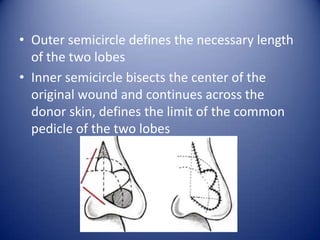 • Outer semicircle defines the necessary length
of the two lobes
• Inner semicircle bisects the center of the
original wound and continues across the
donor skin, defines the limit of the common
pedicle of the two lobes

 