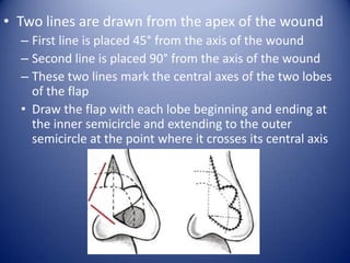 • Two lines are drawn from the apex of the wound
– First line is placed 45° from the axis of the wound
– Second line is placed 90° from the axis of the wound
– These two lines mark the central axes of the two lobes
of the flap
• Draw the flap with each lobe beginning and ending at
the inner semicircle and extending to the outer
semicircle at the point where it crosses its central axis

 
