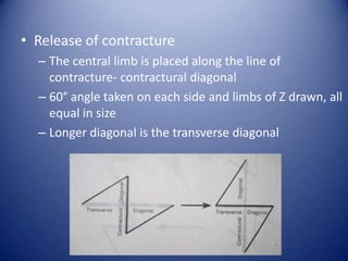 • Release of contracture
– The central limb is placed along the line of
contracture- contractural diagonal
– 60° angle taken on each side and limbs of Z drawn, all
equal in size
– Longer diagonal is the transverse diagonal

 