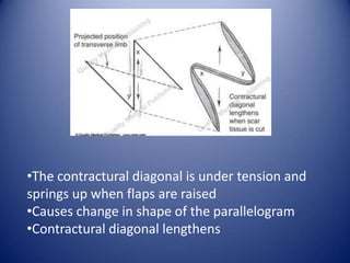 •The contractural diagonal is under tension and
springs up when flaps are raised
•Causes change in shape of the parallelogram
•Contractural diagonal lengthens

 