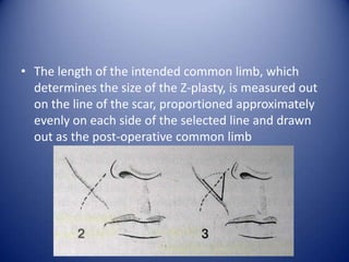 • The length of the intended common limb, which
determines the size of the Z-plasty, is measured out
on the line of the scar, proportioned approximately
evenly on each side of the selected line and drawn
out as the post-operative common limb

 