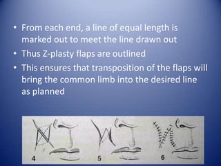 • From each end, a line of equal length is
marked out to meet the line drawn out
• Thus Z-plasty flaps are outlined
• This ensures that transposition of the flaps will
bring the common limb into the desired line
as planned

 