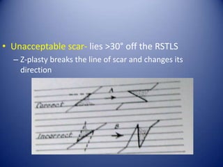 • Unacceptable scar- lies >30° off the RSTLS
– Z-plasty breaks the line of scar and changes its
direction

 