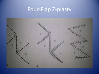 Four-Flap Z-plasty

 