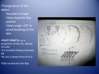 •Triangulation of the
defect
•Isoceles triangle
•Apex towards flap
pedicle
•Apex angle <30° to
avoid buckling of the
skin
•PIVOT POINT D- on a
projection of line AC, atleast
CD>2AC
•E is located midway between
AD
•An arc is drawn from B to D
•CBD constitutes the flap

 