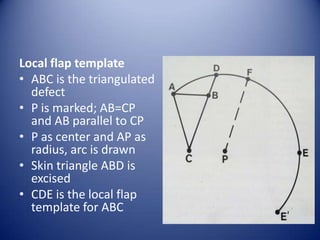 Local flap template
• ABC is the triangulated
defect
• P is marked; AB=CP
and AB parallel to CP
• P as center and AP as
radius, arc is drawn
• Skin triangle ABD is
excised
• CDE is the local flap
template for ABC

 