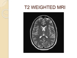 T2 WEIGHTED MRI
 