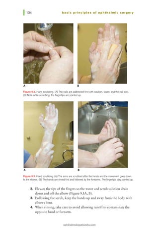 basic pri nci pies of ophthalmic surgery
A
Figure 9.2. Hand scrubbing. (A) The nails are addressed first with solution, water, and 1he nail pick.
(B) Note while scrubbing, 1he fingertips are pointed up.
A 8
F'~gure 9.3. Hand scrubbing. (A) The arms are scrubbed after the hands and the movement goes dawn
to the elbows. (B) The hands are rinsed first and followed bythe forearms. The fingertips stay pointed up.
2. Elevate the tips of the fingers so the water and scrub solution drain
down and off the elbow (Figure 9.3A, B).
3. Following the scrub, keep the hands up and away from the body with
elbows bent.
4. When rinsing, take care to avoid allowing runoff to contaminate the
opposite hand or forearm.
ophthalmologyebooks.com
 
