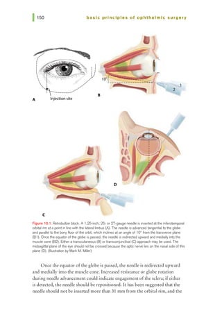 basic principles of ophthalmic surgery
10" -----
------------------~-
1
2
B
A Injection site
D
c
Figure 10.1. Retrobulbar block A 1.25-inch, 25- or 27-gauge needle is inserted at the inferotemporal
orbital rim at a point in line with the lateral limbus (A). The needle is advanced tangential to the globe
and parallel to the bony floor of1he orbit, which inclines at an angle of 1oo from the 11ansverse plane
(B1). Once the equator of the globe is passed, the needle is redirected upward and medially into the
muscle cone (82). Either a transcutaneous (8) or transconjunctival (C) approach may be used. The
midsagittal plane of the eye should not be crossed because the optic nerve lies on the nasal side of this
plane (D). (Illustration by Mark M. Miller)
Once the equator of the globe is passed, the needle is redirected upward
and medially into the muscle cone. Increased resistance or globe rotation
during needle advancement could indicate engagement of the sclera; if either
is detected, the needle should be repositioned. It has been suggested that the
needle should not be inserted more than 31 mm from the orbital rim, and the
 