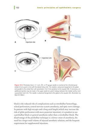 basic principles of ophthalmic surgery
D
Figure 10.2. Peribulbar block. A 1-inch, 25- or 27-gauge needle is inserted at the inferotemporal
orbital rim at a point in line with the lateral limbus (A). The needle is advanced tangential to the globe
and parallel to the orbital floor with penetration 3 to 4 mm posterior to the equator (B). If necessary, an
additional injection may be made in tne upper eyelid at a point midway between the medial canthus and
supraorbital notch (C). The needle is advanced tangential to the globe to the equator (D). (Illustration by
Mark M. Miller)
block is the reduced risk of complications such as retrobulbar hemorrhage,
scleral perforation, central nervous system anesthesia, and optic nerve damage.
In patients with high myopia and a long axial length (which may increase the
risk of globe perforation with more posterior injection), it is prudent to use
a peribulbar block or general anesthesia rather than a retrobulbar block. The
disadvantage of the peribulbar technique is a slower onset of anesthesia, the
need for a larger total volume of injected anesthetic solution, and the frequent
requirement for supplemental injections.
 