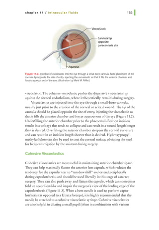 chapter 11 I intraocular flu ids
Cannula tip
opposite
paracentesis site
Figure 11.2. Injection ofviscoelastic into the eye 1hrough a small-bore cannula. Note placement of1he
cannula tip opposite 1he site of entry, injecting the viscoelastic so 1hat it fills 1he anterior chamber and
forces aqueous out of the eye. (lllusbation by Mark M. Miller)
viscoelastic. The cohesive viscoelastic pushes the dispersive viscoelastic up
against the corneal endothelium, where it theoretically remains during surgery.
Viscoelastics are injected into the eye through a small-bore cannula,
usually just prior to the creation of the corneal or scleral wound. The tip ofthe
cannula should be placed opposite the site of entry, injecting the viscoelastic so
that it fills the anterior chamber and forces aqueous out of the eye (Figure 11.2).
Underfilling the anterior chamber prior to the phacoemulsification incision
results in a soft eye that tends to collapse and can result in awound length longer
than is desired. Overfilling the anterior chamber steepens the corneal curvature
and can result in an incision length shorter than is desired. Hydroxypropyl
methylcellulose can also be used to coat the corneal surface, obviating the need
for frequent irrigation by the assistant during surgery.
Cohesive Viscoelastics
Cohesive viscoelastics are most useful in maintaining anterior chamber space.
They can help maximally flatten the anterior lens capsule, which reduces the
tendency for the capsular tear to "run downhill., and extend peripherally
during capsulorrhexis, and should be used liberally in this stage of cataract
surgery. They can also push away and flatten the capsule, which can sometimes
fold up accordion-like and impair the surgeon's view ofthe leading edge of the
capsulorrhexis (Figure 11.3). When a bent needle is used to perform capsu-
lorrhexis (as opposed to a Utrata forceps), it is highly recommended that the
needle be attached to a cohesive viscoelastic syringe. Cohesive viscoelastics
are also helpful in dilating a small pupil (often in combination with various
 