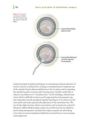 Figure 11.3. Use of
viscoelastic to flatten
the capsulorrhexis flap.
(Illustration by Mark M.
Miller)
basic principles ot ophthalmic surgery
-~+----Capsule flap folding
backon itself
'--~~-- Capsuleflap flattened
outafter injection
ofviscoelastic
mechanical pupil-stretching techniques), in maintaining maximal separation of
nuclear sections to facilitate lens cracking, in manipulating lens fragments out
of the capsular bag for phacoemulsification in the iris plane, and in expanding
the capsular bag prior to intraocular lens placement. Another useful role of
cohesive viscoelastics is in "viscodissection." In this technique, subincisional
cortex which is difficult to remove can be separated from the posterior cap-
sule and pushed into the peripheral capsular bag (Figure 11.4), where it can be
more safely and easily aspirated after placement of the intraocular lens. The
use ofultra-high viscosity cohesive viscoelastics such as hyaluronic acid 2.3%
(Healon5, Abbott Medical Optics, Santa Ana, California) may be helpful in
maintaining intraoperative mydriasis but requires special care when being
removed so as to prevent phacoemulsification wound burns or severe postop-
erative glaucoma.
 