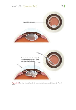 chapter 11 I intraocular fluids
Use ofviscodissection to push
subincisional cortex out of the
peripheral capsular bag
Fi11ure 11.4. Technique of viscodissedion to loosen subincisional cortex. (Illustration by Mark M.
Miller)
 