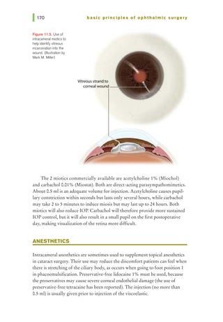 Figure 11.5. Use of
intracameral miotics to
help identifyvitreous
incarceration into the
wound. (Illustration by
Mark M. Miller)
basic pri nci pies of ophthalmic surgery
Vitreous strand to
corneal wound
The 2 miotics commercially available are acetylcholine 1% (Miochol)
and carbachol 0.01% (Miostat). Both are direct-acting parasympathomimetics.
About 0.5 ml is an adequate volume for injection. Acetylcholine causes pupil-
lary constriction within seconds but lasts only several hours, while carbachol
may take 2 to 5 minutes to induce miosis but may last up to 24 hours. Both
miotics will also reduce lOP. Carbachol will therefore provide more sustained
IOP control, but it will also result in a small pupil on the first postoperative
day, making visualization ofthe retina more difficult.
ANESTHETICS
Intracameral anesthetics are sometimes used to supplement topical anesthetics
in cataract surgery. Their use may reduce the discomfort patients can feel when
there is stretching of the ciliary body, as occurs when going to foot position 1
in phacoemulsification. Preservative-free lidocaine 1% must be used, because
the preservatives may cause severe corneal endothelial damage (the use of
preservative-free tetracaine has been reported). The injection (no more than
0.5 ml) is usually given prior to injection of the viscoelastic.
 