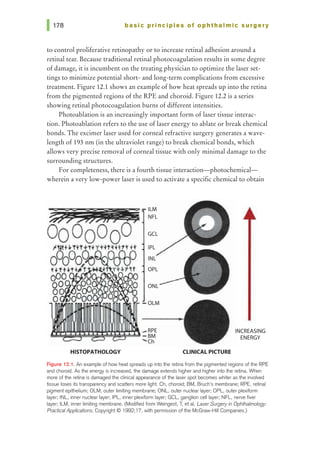basic pri nci pies of ophthalmic surgery
to control proliferative retinopathy or to increase retinal adhesion around a
retinal tear. Because traditional retinal photocoagulation results in some degree
of damage, it is incumbent on the treating physician to optimize the laser set-
tings to minimize potential short- and long-term complications from excessive
treatment. Figure 12.1 shows an example of how heat spreads up into the retina
from the pigmented regions of the RPE and choroid. Figure 12.2 is a series
showing retinal photocoagulation burns ofdifferent intensities.
Photoablation is an increasingly important form of laser tissue interac-
tion. Photoablation refers to the use of laser energy to ablate or break chemical
bonds. The ex:cimer laser used for corneal refractive surgery generates a wave-
length of 193 nm (in the ultraviolet range) to break chemical bonds, which
allows very precise removal of corneal tissue with only minimal damage to the
surrounding structures.
For completeness, there is a fourth tissue interaction-photochemical-
wherein a very low-power laser is used to activate a specific chemical to obtain
HISTOPATliOLOGY
ILM
NFL
ONL
I
- OLM
CLINICAL PICTURE
INCREASING
ENERGY
F'19ure 12.1. An example of how heat spreads up into the retina from the pigmented regions of1he RPE
and choroid. As 1he energy is increased, the damage extends higher and higher into 1he retina. When
more of1he retina is damaged the clinical appearance of the laser spot becomes whiter as the involved
tissue loses its transparency and scatters more light. Ch, choroid; BM, Bruch's membrane; RPE, retinal
pigment epithelium; OLM, outer limiting membrane; ONL, outer nudear layer; OPL, outer plexiform
layer; INL, inner nudear layer; IPL, inner plexiform layer; GCL, ganglion cell layer; NFL, nerve fiver
layer; ILM, inner limiting membrane. (Modified from Weingest, T, et al, LaserSurgery in Ophthalmology:
Practical Applications, Copyright@ 1992;17, with permission of the McGraw-Hill Companies.)
 