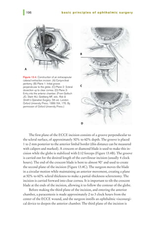 basic pri nci pies of ophthalmic surgery
Figure 13.4. Construction of an extracapsular
cataract extraction incision. (A) Conjunctival
peritomy. (B) Plane 1: Initial groove
perpendicular to the globe. (C) Plane 2: Scleral
dissection up to clear cornea. (D) Plane 3:
Entry into the anterior chamber. (From Gottsch
JD, Stark WJ, Goldberg MF, eds. Rob &
Smith's Operative Surgery. 5th ed. London:
Oxford University Press; 1999:164, 176. By
permission of Oxford University Press.)
B
c
The first plane of the ECCE incision consists of a groove perpendicular to
the scleral surface, of approximately 50% to 60% depth. The groove is placed
1 to 2 mm posterior to the anterior limbal border (this distance can be measured
with calipers and marked). A crescent or diamond blade is used to make this in-
cision while the globe is stabilized with 0.12 forceps (Figure 13.4B). The groove
is carried out for the desired length of the curvilinear incision (usually 4 clock
hours). The end of the crescent blade is bent to almost 90° and used to create
the second plane of the incision (Figure 13.4C). The surgeon moves the blade
in a circular motion while maintaining an anterior movement, creating a plane
at 50% to 60% scleral thickness to make a partial-thickness sclerectomy. The
incision is carried forward into clear cornea. It is important to tilt the crescent
blade at the ends ofthe incision, allowing it to follow the contour of the globe.
Before making the third plane of the incision, and entering the anterior
chamber, a paracentesis is made approximately 2 to 3 clock hours from the
center of the ECCE wound, and the surgeon instills an ophthalmic viscosurgi-
cal device to deepen the anterior chamber. The third plane of the incision is
 