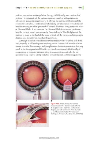 chapter 13 I wound construction in cataract surgery
patients to continue anticoagulation therapy. Additionally, as a conjunctival
peritomy is not required, the incision does not interfere with previous or
subsequent glaucoma surgery nor is it affected by scarring or thinning of the
conjunctiva or sclera. The technique of creating a 3-plane clear corneal incision
involves making an initial groove (half corneal thickness) using a crescent blade
or diamond blade. A keratome or the diamond blade is then used to dissect a
lamellar corneal tunnel approximately 2 mm in length. The third plane of the
incision is made as the heel of the blade is lifted off the cornea, and the point is
directed into the anterior chamber (Figure 13.6).
Although the clear corneal incision takes the least time to create and, ifcre-
ated properly, is self-sealing (not requiring suture closure), it is associated with
several potential disadvantages and complications. Inadequate construction may
result in the intraoperative difficulties previously mentioned. Additionally, if
compromise ofposterior capsular integrity occurs intraoperatively, the sur-
geon may need to close a temporal clear corneal incision and move superiorly
A
c
B
Figure 13.6. Three-planed clear corneal
incision made with a diamond blade. (A and
B) Surgeon's view. (C) Cross-sectional view.
(Reproduced with permission. From Burratto
L, ed. Phacoemulsification Principles and
Techniques. Thorofare, NJ: Slack Inc, 1998:46.)
ophthalmologyebooks.com
 