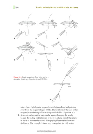 basic principles of ophthalmic surgery
(
A
D E
Figure 14.1. Simple square knot. Refer to the text for a
description of each part. (Illustration by Mark M. Miller)
suture (for a right-handed surgeon) with the jaws closed and pointing
away from the surgeon (Figure 14.1B). The first loop of the knot is then
wrapped around the tip of the waiting needle holder (Figure 14.1C).
2. A second and even third loop can be wrapped around the needle
holder, depending on the tension of the wound and size of the suture,
in order to prevent the wound from gaping after the first loops are
tied down. (For example, 3loops may be required for 10-0 nylon
ophthalmologyebooks.com
 