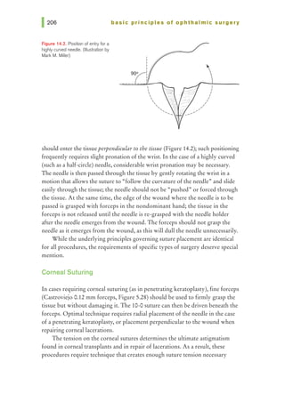 Figure 14.2. Position of entry for a
highly curved needle. (Illustration by
Mark M. Miller)
basic principles of ophthalmic surgery
I
I
I
I
I
---~LjI
I




'',................._
--.........,.·-"'
I
I
I
I
I
I
I
/
should enter the tissue perpendicular to the tissue (Figure 14.2); such positioning
frequently requires slight pronation of the wrist. In the case of a highly curved
(such as a half-circle) needle, considerable wrist pronation may be necessary.
The needle is then passed through the tissue by gently rotating the wrist in a
motion that allows the suture to "follow the curvature of the needle" and slide
easily through the tissue; the needle should not be "pushed" or forced through
the tissue. At the same time, the edge of the wound where the needle is to be
passed is grasped with forceps in the nondominant hand; the tissue in the
forceps is not released until the needle is re-grasped with the needle holder
after the needle emerges from the wound. The forceps should not grasp the
needle as it emerges from the wound, as this will dull the needle unnecessarily.
While the underlying principles governing suture placement are identical
for all procedures, the requirements of specific types of surgery deserve special
mention.
Corneal Suturing
In cases requiring corneal suturing (as in penetrating keratoplasty), fine forceps
(Castroviejo 0.12 mm forceps, Figure 5.28) should be used to firmly grasp the
tissue but without damaging it. The 10-0 suture can then be driven beneath the
forceps. Optimal technique requires radial placement of the needle in the case
of a penetrating keratoplasty, or placement perpendicular to the wound when
repairing corneal lacerations.
The tension on the corneal sutures determines the ultimate astigmatism
found in corneal transplants and in repair of lacerations. As a result, these
procedures require technique that creates enough suture tension necessary
 