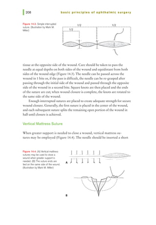 Figure 14.3. Simple interrupted
suture. (Illustration by Mark M.
Miller)
basic principles of ophthalmic surgery
1/2 1/2
r--------------------v-------------------~
:
1
___ ]1!____ :1 ~ I
I 1 II I
11 1 II I
II I II I
II 1 II I
~ " I
~~
'
tissue at the opposite side of the wound. Care should be taken to pass the
needle at equal depths on both sides of the wound and equidistant from both
sides of the wound edge (Figure 14.3). The needle can be passed across the
wound in 1 bite or, if the pass is difficult, the needle can be re-grasped after
passing through the initial side of the wound and passed through the opposite
side of the wound in a second bite. Square knots are then placed and the ends
of the suture are cut; when wound closure is complete, the knots are rotated to
the same side of the wound.
Enough interrupted sutures are placed to create adequate strength for secure
wound closure. Generally, the first suture is placed in the center of the wound,
and each subsequent suture splits the remaining open portion of the wound in
half until closure is achieved.
Vertical Mattress Suture
When greater support is needed to close a wound, vertical mattress su-
tures may be employed (Figure 14.4). The needle should be inserted a short
Figure 14.4. (A) Vertical mattress
sutures may be used to close a
wound when greater support is
needed. (B) The suture ends are
tied on the same side of the wound.
(Illustration by Mark M. Miller)
B
.
I
'

'' ' ..........___
----.........
/
"
I
/
I
I
I
 
