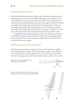 basic principles of ophthalmic surgery
Horizontal Mattress Suture
The horizontal mattress suture is largely used to minimize wound tension by
displacing tension away from the wound edge (Figure 14.6). To place a hori-
zontal mattress suture, the surgeon enters on 1 side of the wound, drives the
needle across the underlying tissue, and exits on the opposite side of the wound
an equally short distance from the insertion. The surgeon then re-enters on
the second side laterally, again equidistant from the wound edge, and drives
the needle back through and out the first side, creating a "rectangle"' out of the
suture. The ends of the suture are then tied on the same side of the wound.
In ophthalmology, horizontal mattress sutures are frequently used when
tying bolsters across the upper and lower eyelids to close the palpebral aper-
ture temporarily. They are also sometimes employed to close scleral tunnel
incisions after cataract surgery.
Simple Continuous (Running) Suture
Running sutures permit the surgeon to close wounds much more rapidly
than other techniques (Figure 14.7A). Essentially, a simple suture is placed
in the same fashion as an interrupted suture at 1 end of the wound, but in
the case of running sutures, the thread attached to the needle is not cut. The
Figure 14.6. Horizontal mattress suture.
(Illustration by Mark M. Miller)
Figure 14.7. (A) Simple continuous (running) suture.
(B) Altemate final knot. (Illustration by Mark M. Miller)
A B
 