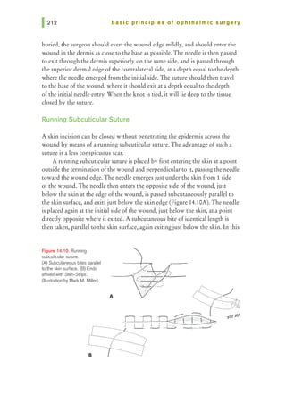 basic principles of ophthalmic surgery
buried, the surgeon should evert the wound edge mildly, and should enter the
wound in the dermis as close to the base as possible. The needle is then passed
to exit through the dermis superiorly on the same side, and is passed through
the superior dermal edge of the contralateral side, at a depth equal to the depth
where the needle emerged from the initial side. The suture should then travel
to the base of the wound, where it should exit at a depth equal to the depth
of the initial needle entry. When the knot is tied, it will lie deep to the tissue
closed by the suture.
Running Subcuticular Suture
A skin incision can be closed without penetrating the epidermis across the
wound by means of a running subcuticular suture. The advantage of such a
suture is a less conspicuous scar.
A running subcuticular suture is placed by first entering the skin at a point
outside the termination of the wound and perpendicular to it, passing the needle
toward the wound edge. The needle emerges just under the skin from 1 side
of the wound. The needle then enters the opposite side of the wound, just
below the skin at the edge of the wound, is passed subcutaneously parallel to
the skin surface, and exits just below the skin edge (Figure 14.10A). The needle
is placed again at the initial side of the wound, just below the skin, at a point
directly opposite where it exited. A subcutaneous bite of identical length is
then taken, parallel to the skin surface, again exiting just below the skin. In this
Figure 14.10. Running
subcuticular suture.
(A) Subcutaneous bites parallel
to the skin surface. (B) Ends
affixed with Steri-Strips.
(Illustration by Mark M. Miller)
 