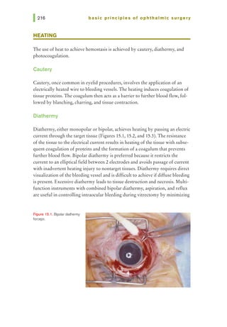 basic pri nci pies of ophthalmic surgery
HEATING
The use of heat to achieve hemostasis is achieved by cautery, diathermy, and
photocoagulation.
Cautery
Cautery, once common in eyelid procedures, involves the application of an
electrically heated wire to bleeding vessels. The heating induces coagulation of
tissue proteins. The coagulum then acts as a barrier to further blood flow, fol-
lowed by blanching, charring, and tissue contraction.
Diathermy
Diathermy, either monopolar or bipolar, achieves heating by passing an electric
current through the target tissue (Figures 15.1, 15.2, and 15.3). The resistance
of the tissue to the electrical current results in heating of the tissue with subse-
quent coagulation ofproteins and the formation of a coagulum that prevents
further blood flow. Bipolar diathermy is preferred because it restricts the
current to an elliptical field between 2 electrodes and avoids passage of current
with inadvertent heating injury to nontarget tissues. Diathermy requires direct
visualization ofthe bleeding vessel and is difficult to achieve if diffuse bleeding
is present. Excessive diathermy leads to tissue destruction and necrosis. Multi-
function instruments with combined bipolar diathermy, aspiration, and reflux
are useful in controlling intraocular bleeding during vitrectomy by minimizing
F'~gure 15.1. Bipolardiathermy
forceps.
 