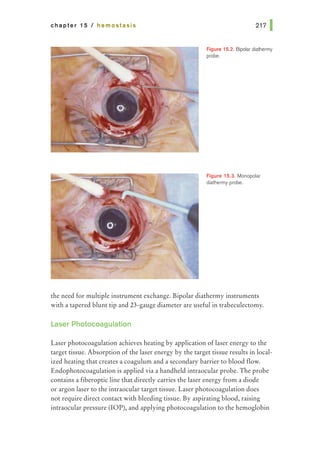 chapter 15 I hemostasis
Rgure 15.2. Bipolar diathermy
probe.
Figure 15.3. Monopolar
diathermy probe.
the need for multiple instrument exchange. Bipolar diathermy instruments
with a tapered blunt tip and 23-gauge diameter are useful in trabeculectomy.
Laser Photocoagulation
Laser photocoagulation achieves heating by application of laser energy to the
target tissue. Absorption of the laser energy by the target tissue results in local-
ized heating that creates a coagulum and a secondary barrier to blood flow.
Endophotocoagulation is applied via a handheld intraocular probe. The probe
contains a fiberoptic line that directly carries the laser energy from a diode
or argon laser to the intraocular target tissue. Laser photocoagulation does
not require direct contact with bleeding tissue. By aspirating blood, raising
intraocular pressure (lOP), and applying photocoagulation to the hemoglobin
 