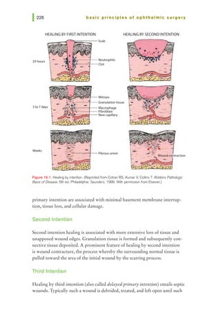 basic pri nci pies of ophthalmic surgery
HEALING BYFIRSTINTENTION HEALING BY SECOND INTENTION
24hours
3to7days
llb:- - t - -- Neutrophils
-w._-~- Ciot
~~- Mitoses
Granulation tissue
~i:!i!,.,----+-- Macrophage
, .;....__...,_ Fibroblast
#L:~
~~~~r--- Newcapillary
Weeks
Figure 16.1. Healing by intention. (Reprinted from Cotran RS, Kumar V, Collins T. Robbins Patflofogic
Basis ofDisease. 6th ed. Philadelphia: Saunders; 1999. With permission from Elsevier.)
primary intention are associated with minimal basement membrane interrup-
tion, tissue loss, and cellular damage.
Second Intention
Second intention healing is associated with more extensive loss of tissue and
unapposed wound edges. Granulation tissue is formed and subsequently con-
nective tissue deposited. A prominent feature of healing by second intention
is wound contracture, the process whereby the surrounding normal tissue is
pulled toward the area of the initial wound by the scarring process.
Third Intention
Healing by third intention (also called delayedprimary intention) entails septic
wounds. Typically such a wound is debrided, treated, and left open until such
 