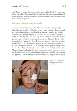 chapter 17 I dressings
ends should be square. Dressings are almost never placed on both eyes because
of the psychological impact of bilateral occlusion. Exceptions include bilateral
enucleations and bilateral intraocular surgery, sometimes performed in infants
with cataracts or glaucoma.
Nonpressure Dressing With a Shield
An eye drop or ointment is usually administered just before a dressing is
placed. Several (usually 4 or 5) pieces of tape of approximately the same length
are prepared ahead of time and placed in a convenient location (eg, the edge
of a table) near the patient's head. An oval eye pad is oriented horizontally
and placed directly above the closed upper eyelid. The superior end of the first
piece of tape is placed on the patient's forehead, and the tape is directed inferi-
orly and slightly temporally through the center of the eye pad to the patient's
cheek (Figure 17.2). Great care is taken not to apply downward pressure on
the eye during this maneuver. The inferior edge of the tape should be placed in
the middle of the cheek and not too close to the corner of the patient's mouth.
The tape should not be placed over the patienes hairline, or removal postoper-
atively will be difficult and painful, especially in children. Other pieces of tape
are applied in a similar manner, progressively nasal and temporal to the center
Figure 17.2. First piece of
tape applied over center of
eye pad.
 