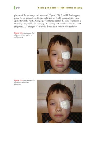 basic pri nci pies of ophthalmic surgery
piece until the entire eye pad is covered (Figure 17.3). A shield that is appro-
priate for the patient's eye (left or right) and age (child versus adult) is then
applied over the patch. A single piece of tape placed in the same orientation as
the first piece placed over the eye pad is usually sufficient to secure the shield
(Figure 17.4). The edges of the shield should be in contact with the bones
Figure 17.3. Appearance after
all pieces of tape applied to
soft dressing.
Figure 17.4. Final appearance
of dressing after shield
placement.
 